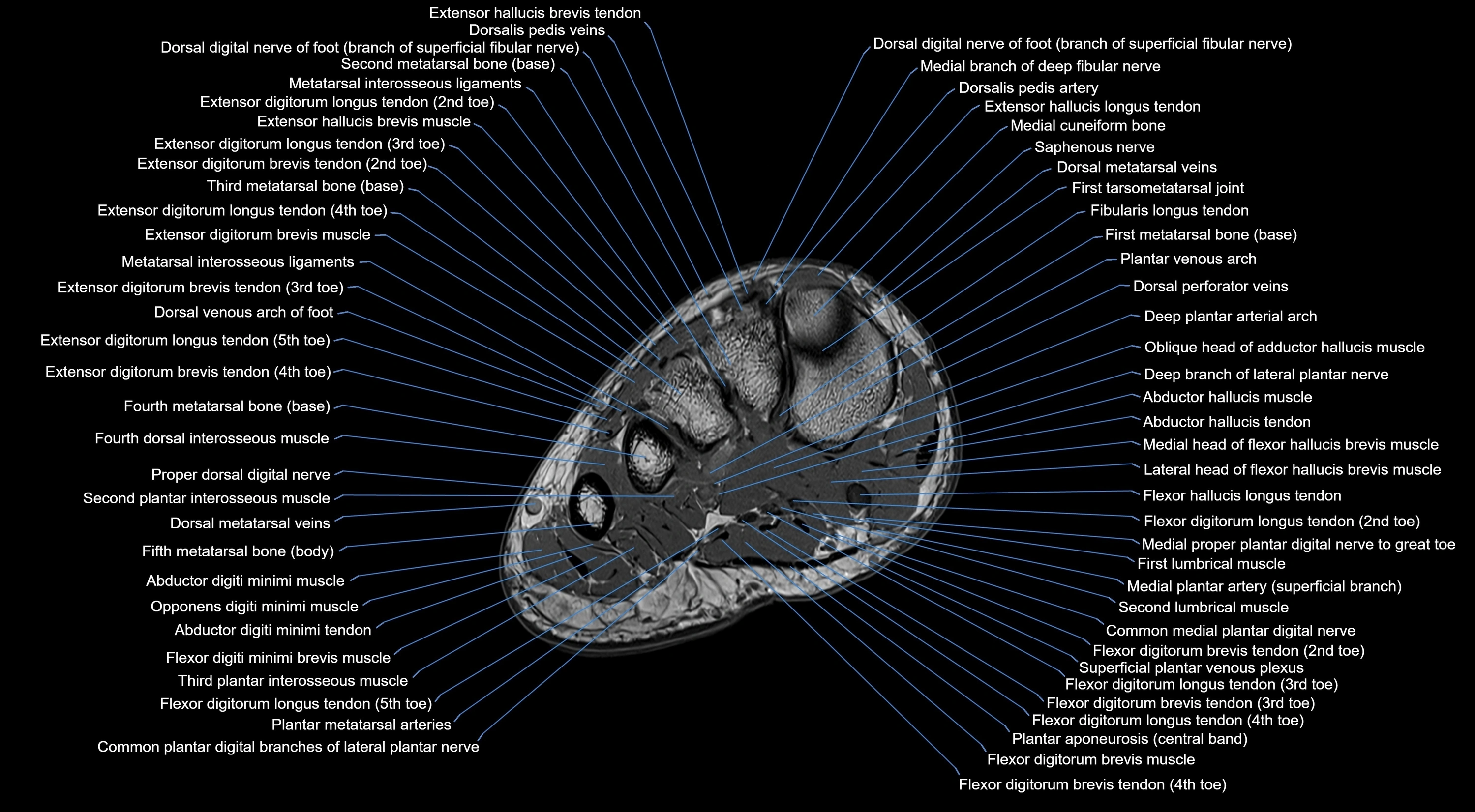 MRI mid foot coronal ligaments cross sectional anatomy 3T  radiology  image-img-00001-00012.webp